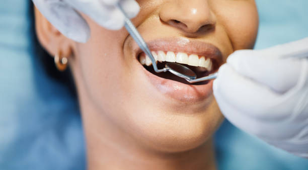 Best Knocked-Out Tooth (Avulsed Tooth) Treatment in Burien, WA